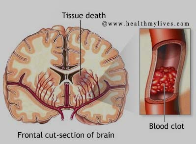 about stroke