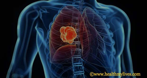 liver cancer