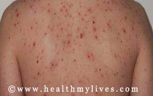syphilis third stage