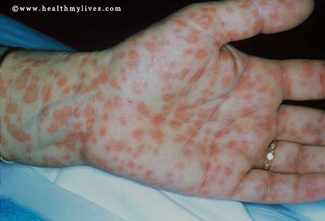 syphilis second stage