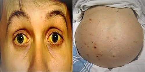 HEPATITIS A SYMPTOMS