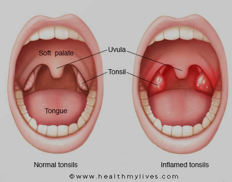 Normal and inflamed tonsils