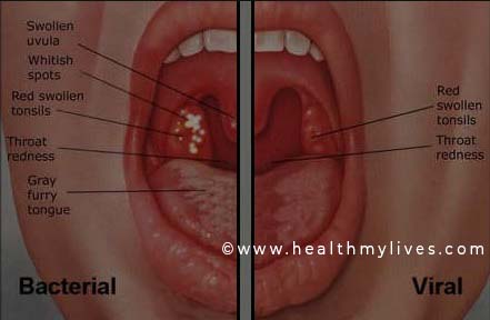 sore throat