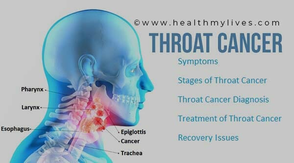 symptoms of throat cancer