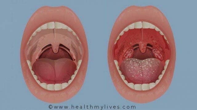 Tonsillitis causes