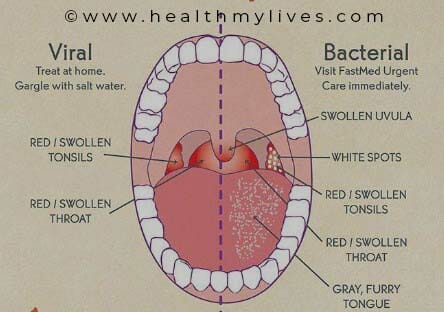 pharyngitis symptoms