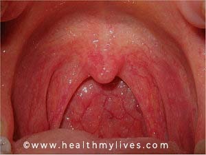 pharyngitis causes