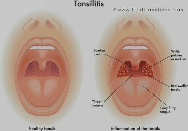 Tonsillitis illustration