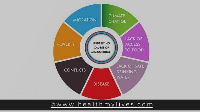 Malnutrition Causes