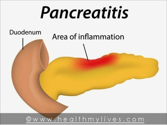 Pancreatitis Causes