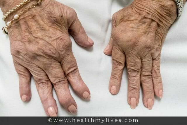 RHEUMATOID ARTHRITIS CAUSES