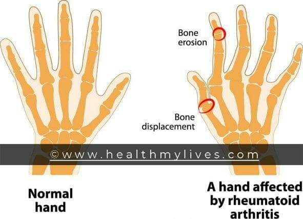 SYMPTOMS OF RHEUMATOID ARTHRITIS