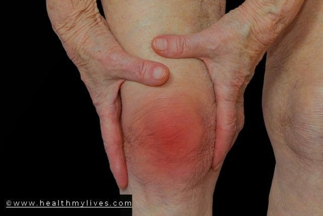 RHEUMATOID ARTHRITIS SYMPTOMS