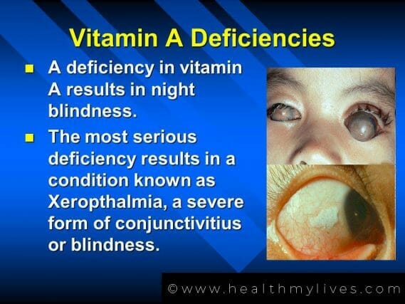 vitamin A deficiency