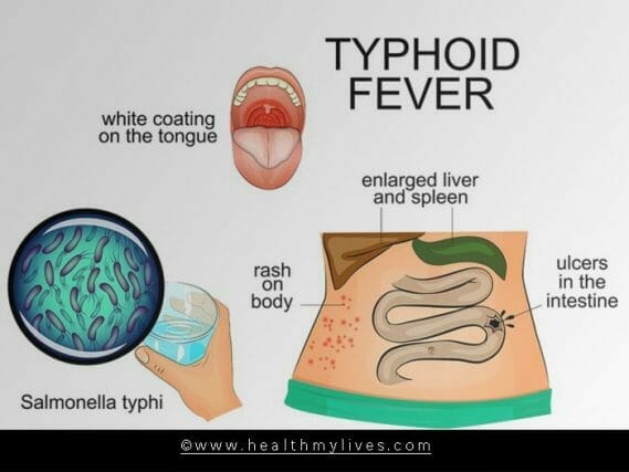 Typhoid symptoms