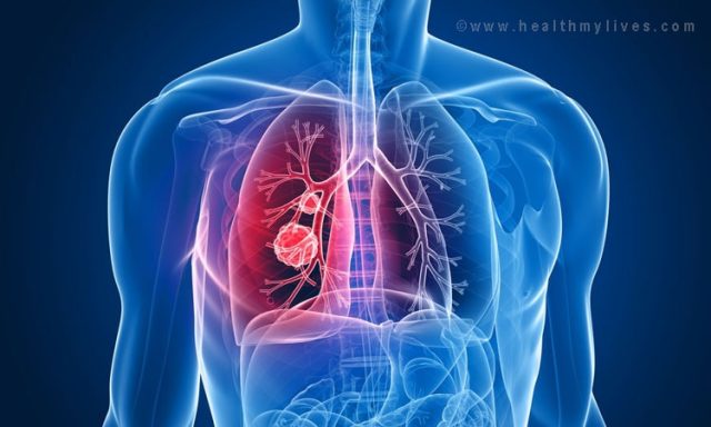 Lung cancer