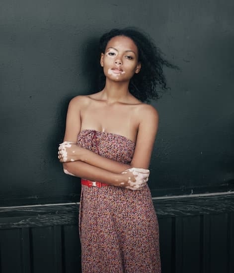 Girl with vitiligo