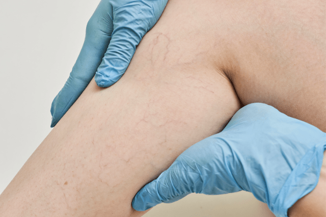 signs of vein disease - featured image